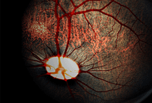 Photo of آنژیوگرافی فلورسین درمقایسه با ERG برای پیش بینی تشخیص بیماری در انسداد ورید شبکیه مرکزی