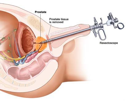 TURBT (TRANSURETHRAL RESECTION OF THE BLADDER TUMOR) SURGERY