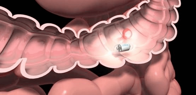 Pill Cam in Intestines